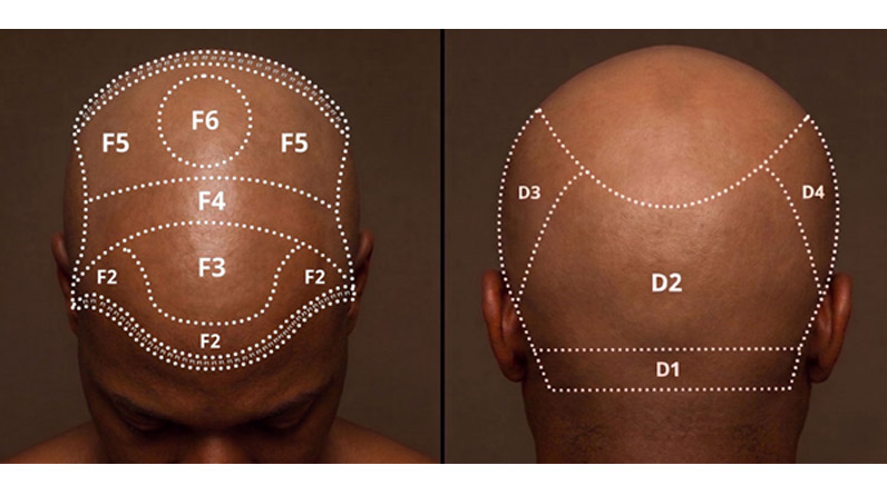 Mapping of the frontal hairline